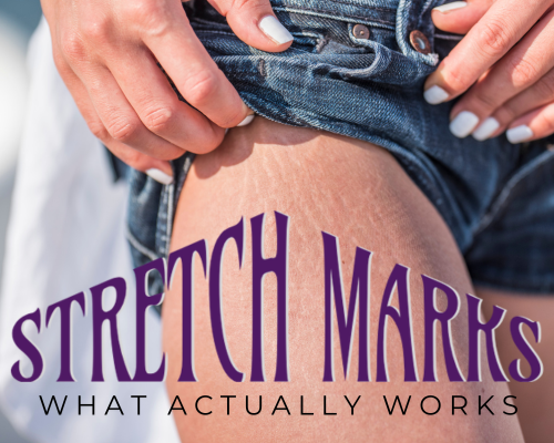 Stretch Marks: Why Creams Don't Work & What Actually Does